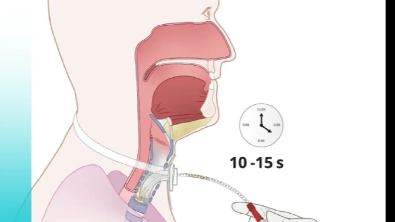 Endotracheális leszívás: így távolítható el biztonságosan a váladék a légcsőből